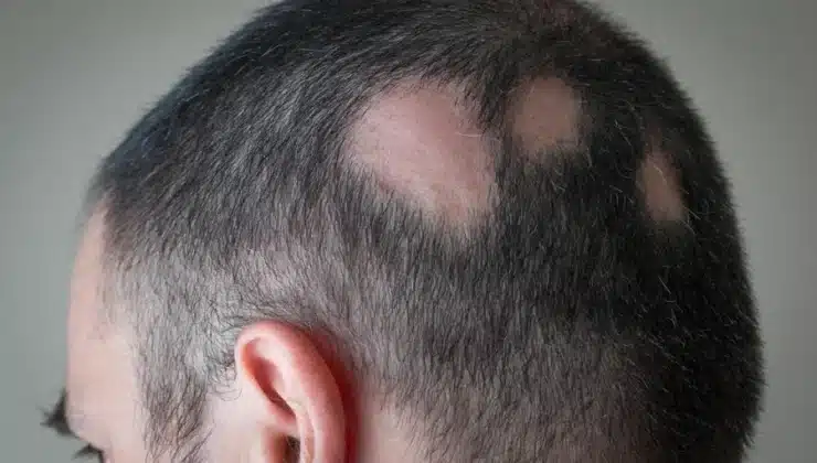 Alopecia